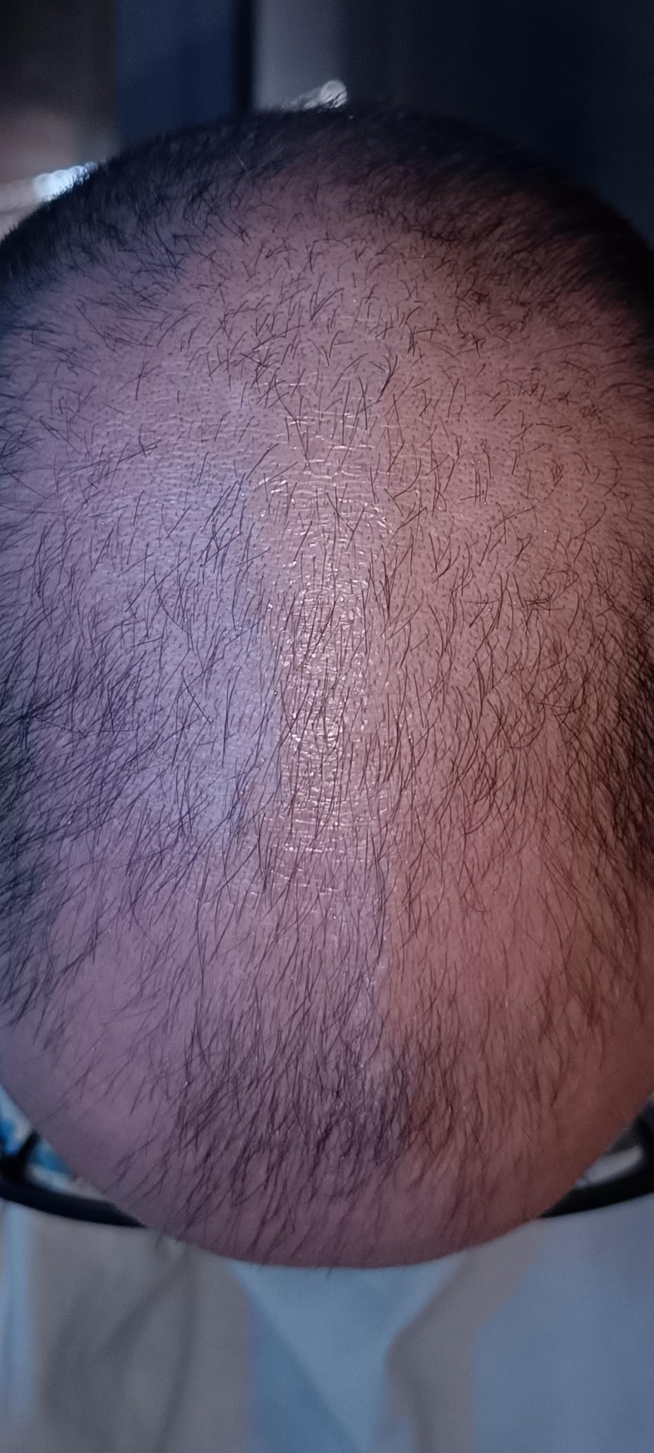 Chevelure plus dense